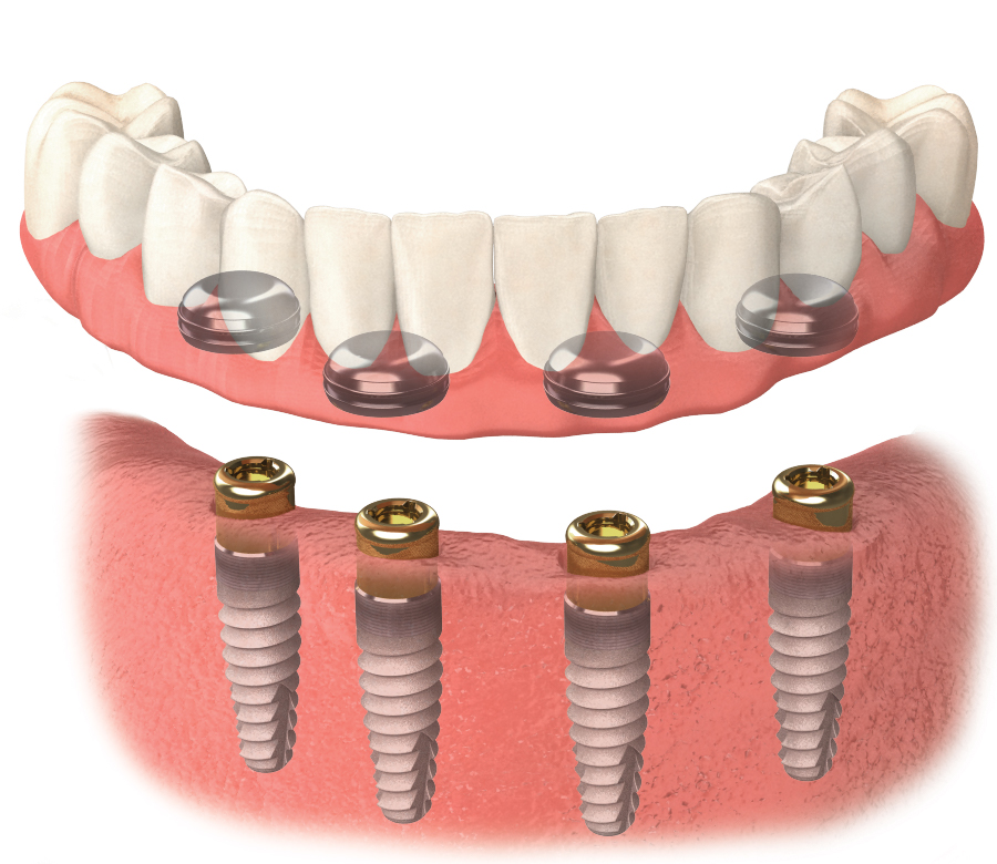 Overdentures Montville Oral Surgery