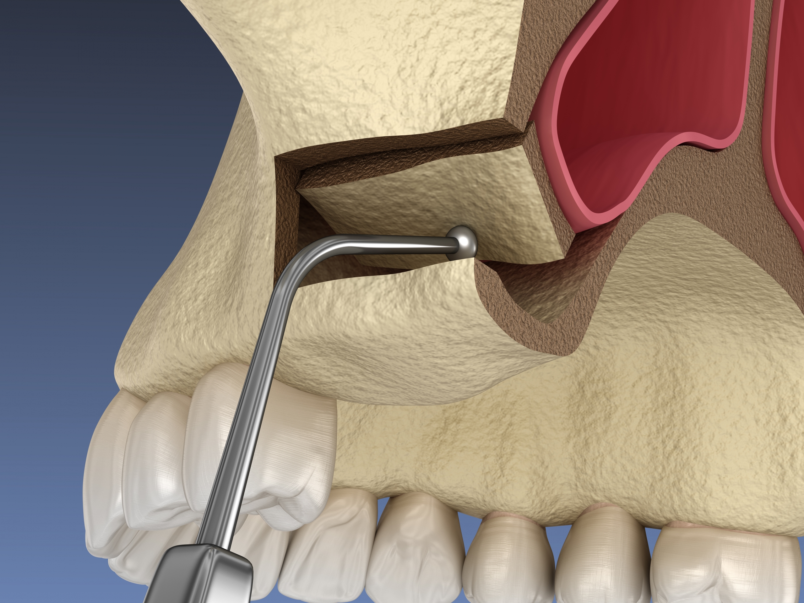 sinus-lift-montville-oral-surgery