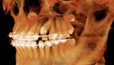 Impacted Tooth Exposure